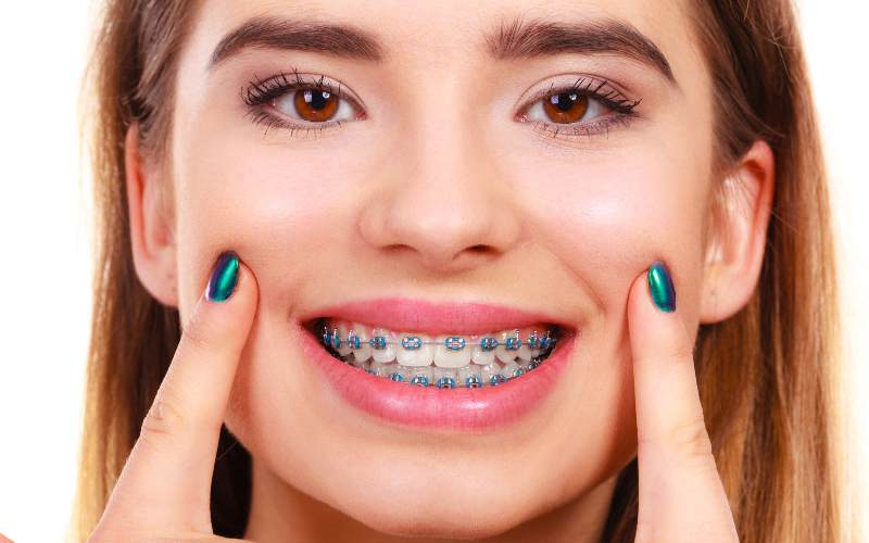 Why Choose Metal Braces