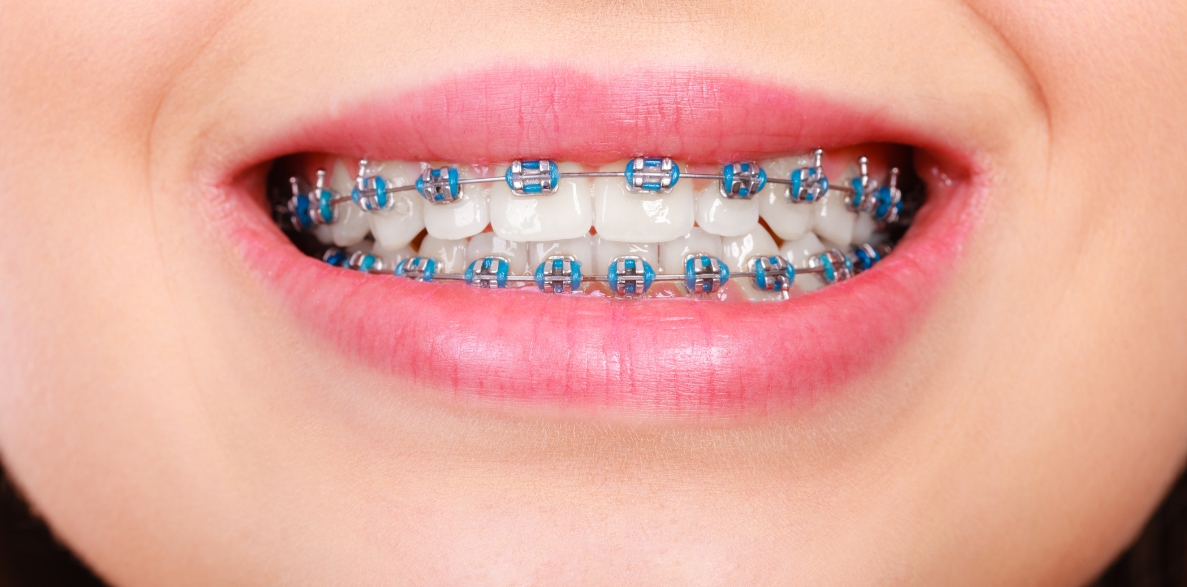 effects of wearing braces