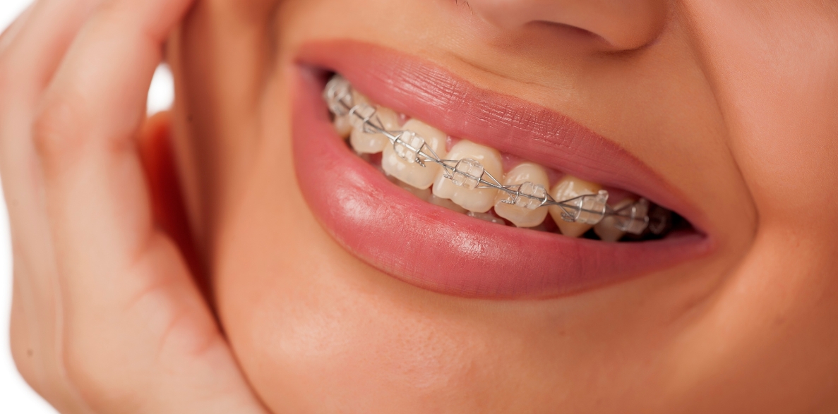 why braces more than cosmetic