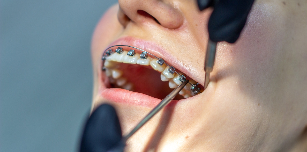 do braces change face shape