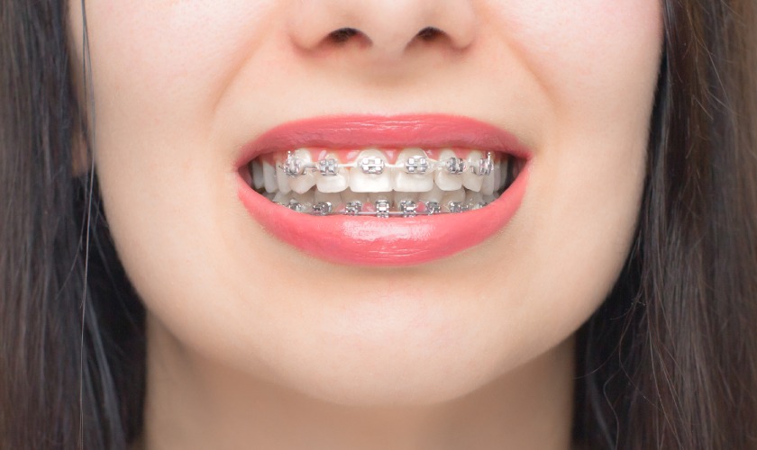 White Spots Around Brackets