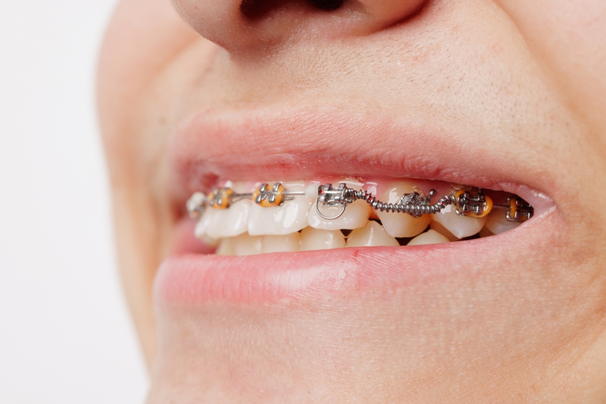 metal-braces-in-Justin